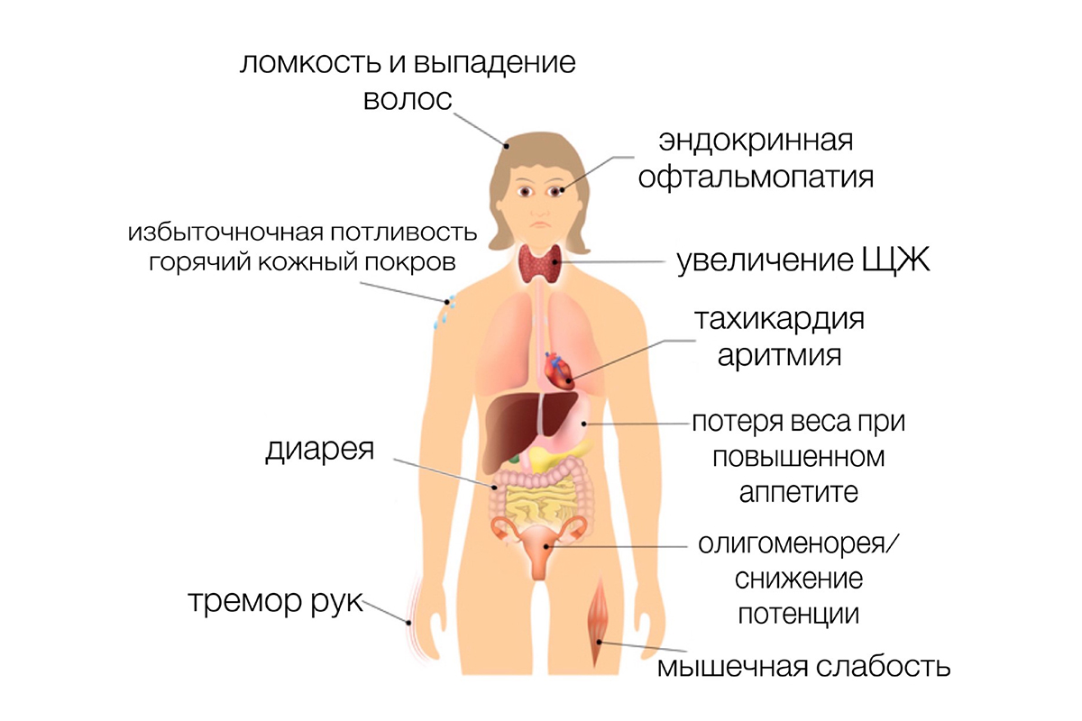 Диффузный токсический зоб