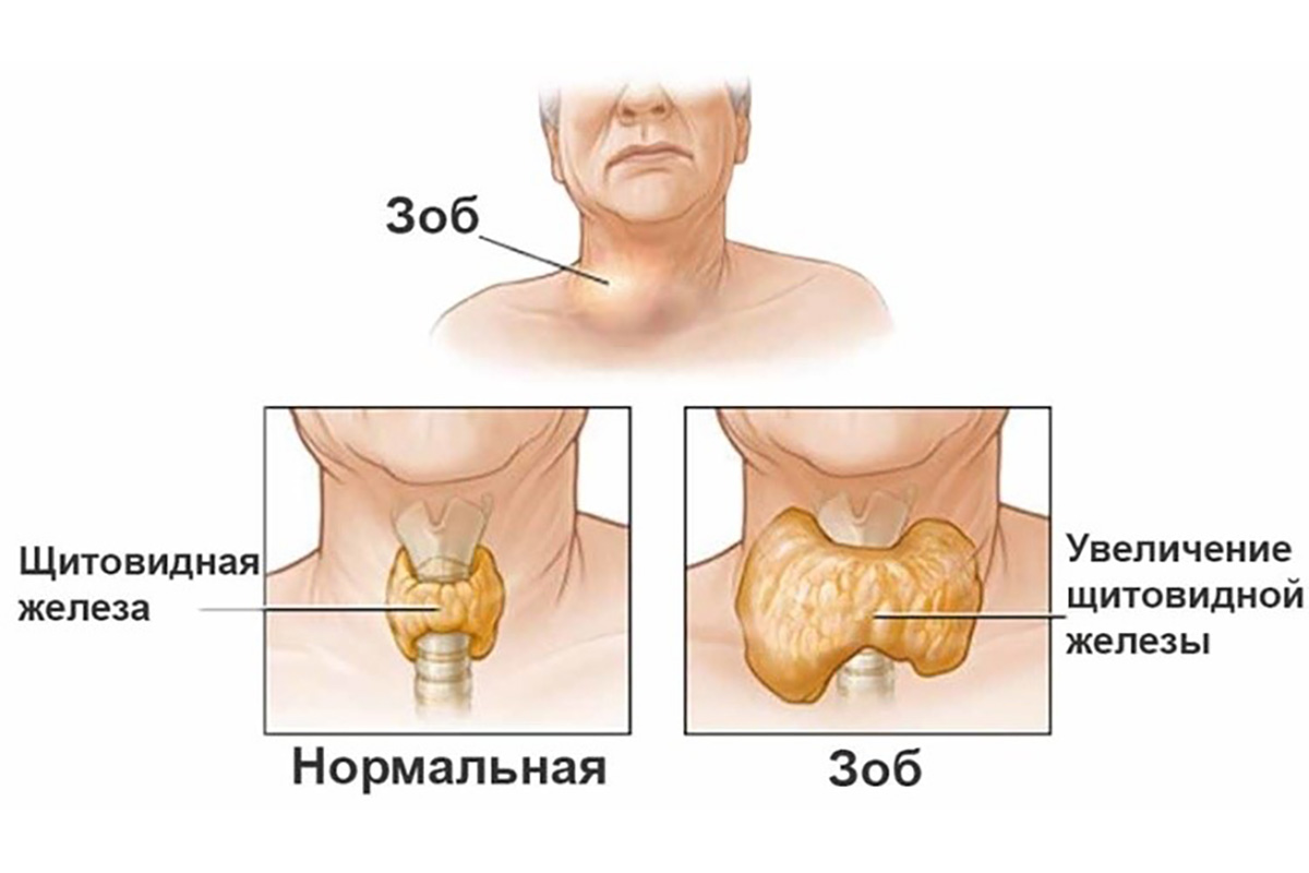 Эутиреоидный узловой коллоидный зоб