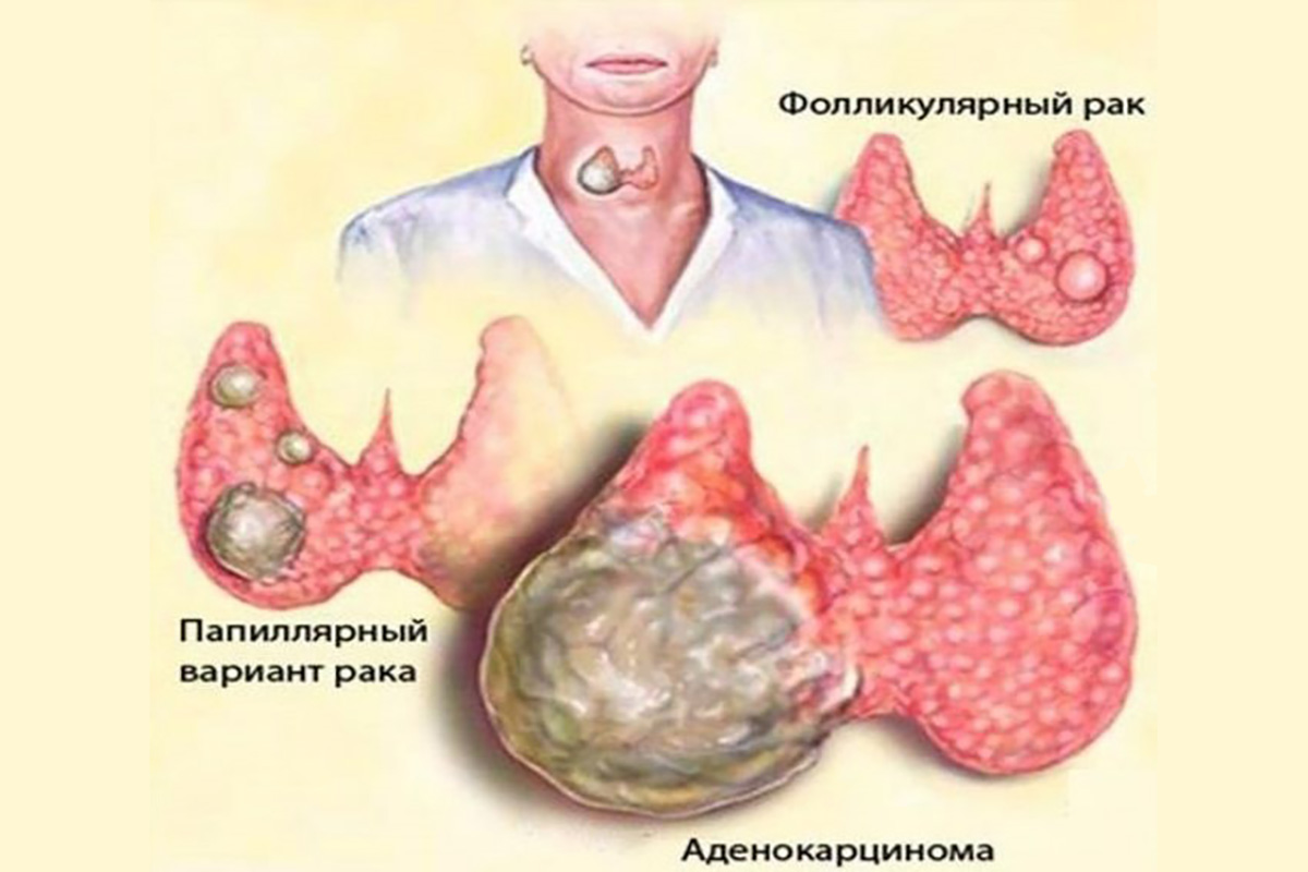 Опухоли щитовидной железы