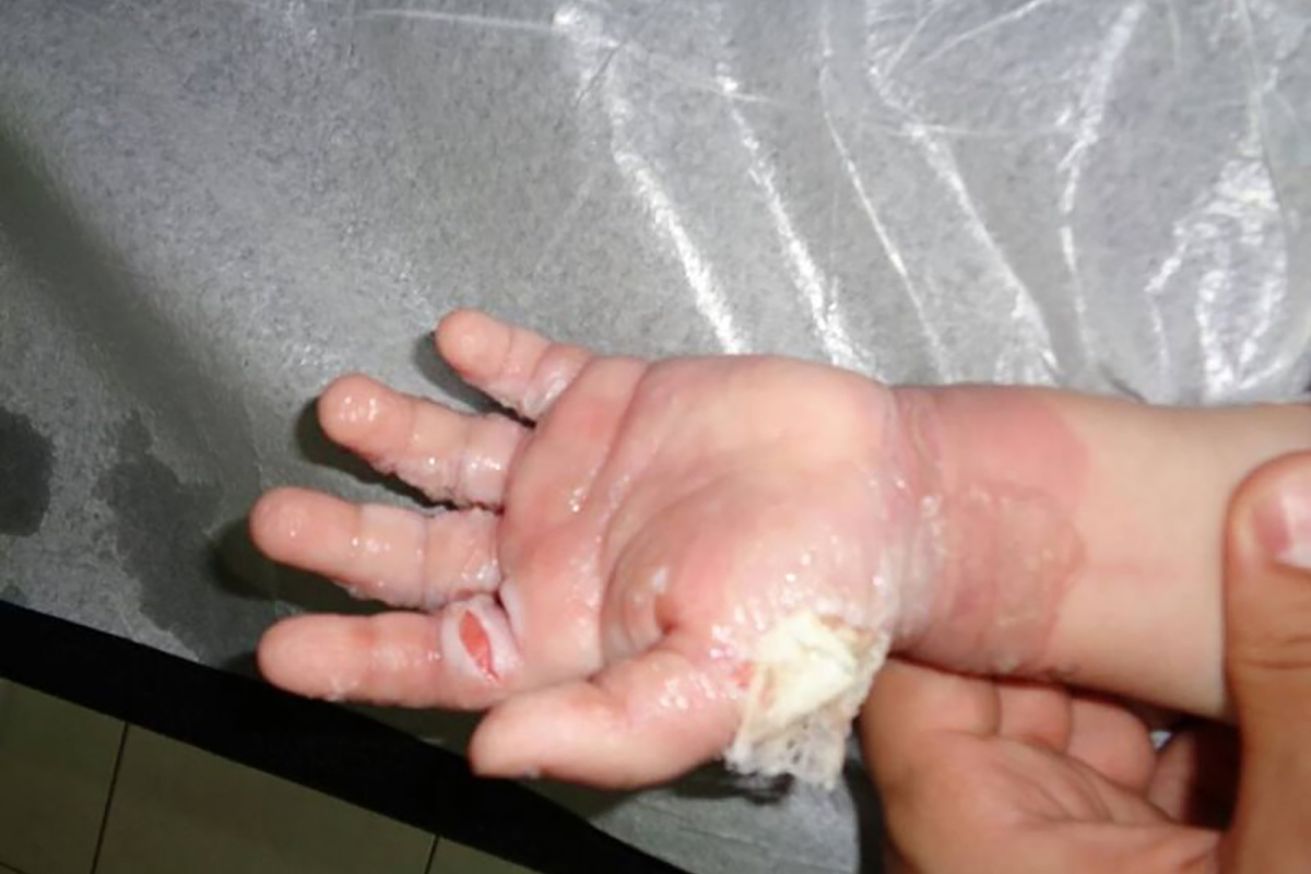 ЕСЛИ ПОСТРАДАЛ РЕБЁНОК? ОЖОГИ У ДЕТЕЙ!