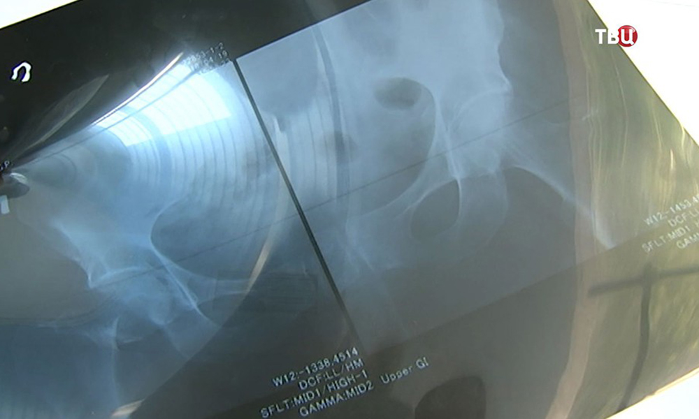 В больнице имени Иноземцева успешно сделали операцию 99-летнему пациенту